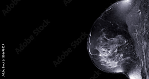 Schilderij op canvas MRI scan of the breasts in an Sagittal view with contrast enhancement
