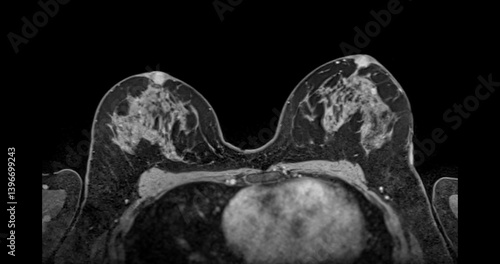Bilde på lerret MRI scan of the breasts in an axial view with contrast enhancement