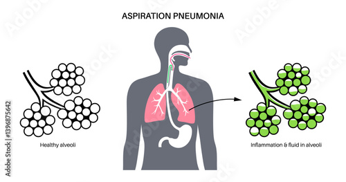 Aspiration pneumonia poster