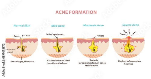 Formation of skin acne or pimple