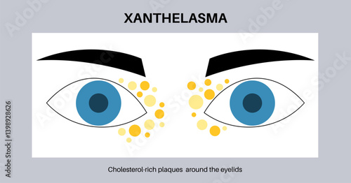 Xanthelasma skin disease
