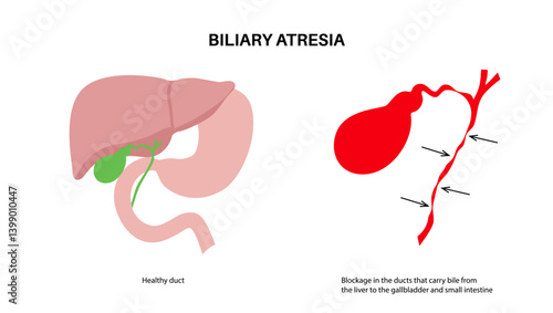 Biliary atresia disease