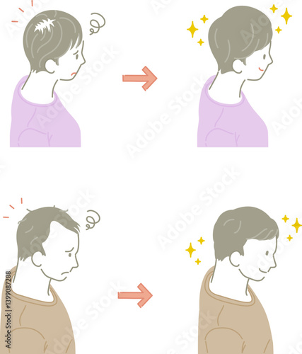 薄毛の男性と女性：治療前と治療後のイラストセット（俯瞰）