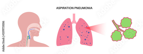Aspiration pneumonia poster