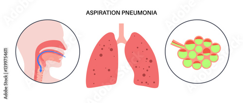 Aspiration pneumonia poster