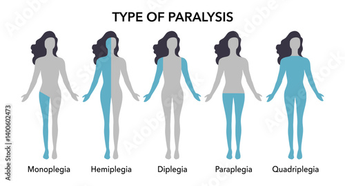 Types of paralysis and limb body parts as medical condition outline diagram. Labeled educational scheme with monoplegia, hemiplegia, diplegia and paraplegia disorder differences vector illustration.