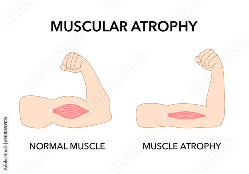 Muscle pain nerve waste injury arm leg lack diet limb nutrition body activity lateral Guillain Barre loss tissue Atrophied poor genetic older frailty Spinal gene mass Polio cord Aging adults body BMI