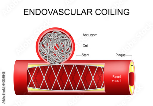 Endovascular coiling. Atherosclerosis and Aneurysm treatment