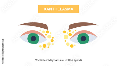 Xanthelasma skin disease