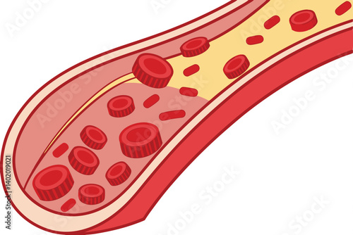 28 Medical illustration, cross-section of blood vessels, red blood cells, cholesterol buildup, arterial plaque, circulatory system, atherosclerosis progression, scientific diagram, detailed anatomy, c