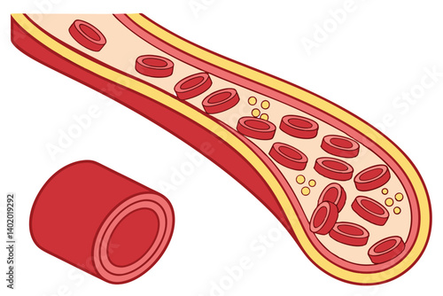 28 Medical illustration, cross-section of blood vessels, red blood cells, cholesterol buildup, arterial plaque, circulatory system, atherosclerosis progression, scientific diagram, detailed anatomy, c