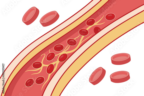 28 Medical illustration, cross-section of blood vessels, red blood cells, cholesterol buildup, arterial plaque, circulatory system, atherosclerosis progression, scientific diagram, detailed anatomy, c