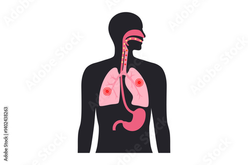 Aspiration pneumonia poster
