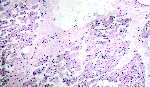 Obraz na plátně Skeletal muscle atrophy, photomicrograph showing decreased fiber size with incre