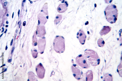 Tableau sur toile Skeletal muscle atrophy, photomicrograph showing decreased fiber size with incre