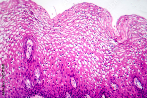 Atypical squamous epithelial hyperplasia, photomicrograph showing thickened stratified epithelium with nuclear atypia and basal layer crowding