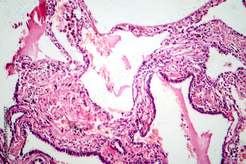Red hepatization stage of lobar pneumonia, photomicrograph showing alveolar exudate with red cells, neutrophils, and fibrin strands