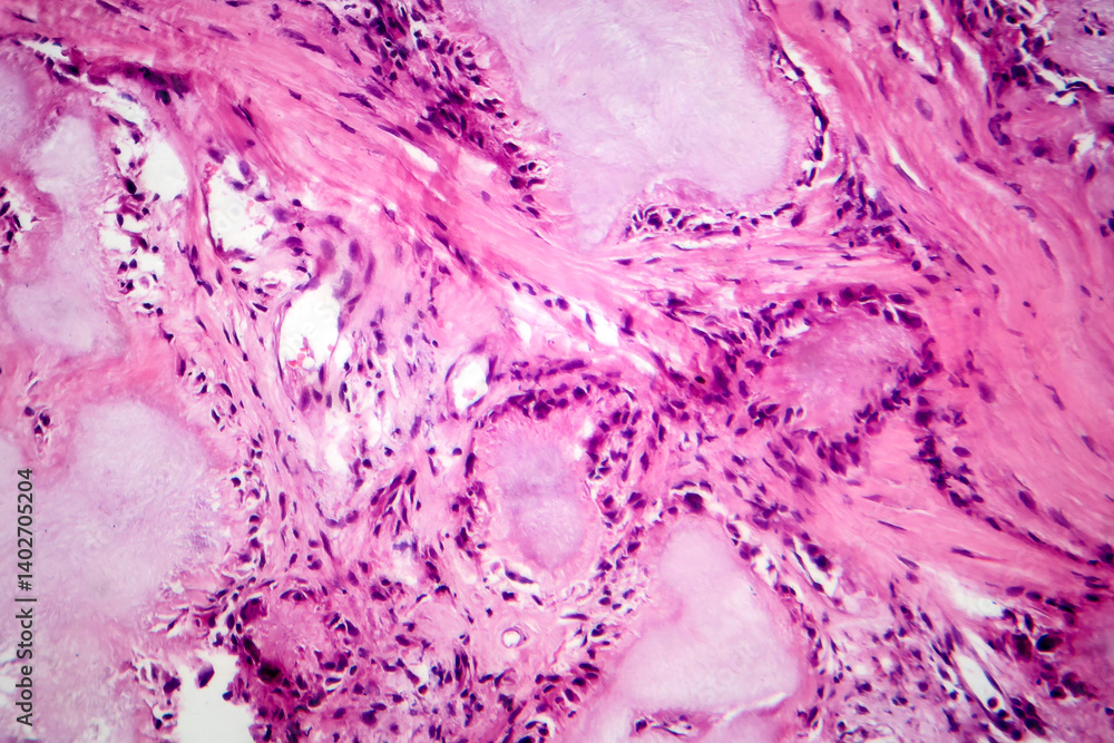 Gout tophus, photomicrograph showing amorphous, eosinophilic material with a foreign-body giant cell reaction and inflammation