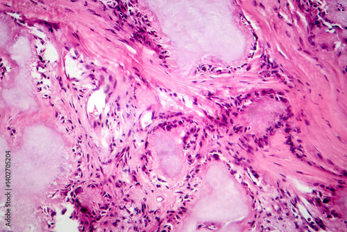 Obraz na płótnie Gout tophus, photomicrograph showing amorphous, eosinophilic material with a foreign-body giant cell reaction and inflammation w salonie