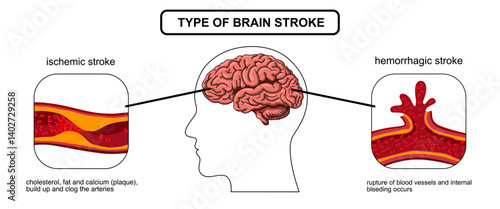 Brain stroke, hemorrhagic and ischemic. Arteriosclerosis, infarct, ischemia, thrombosis disease. Cholesterol in human blood vessels. Medical poster vector illustration.