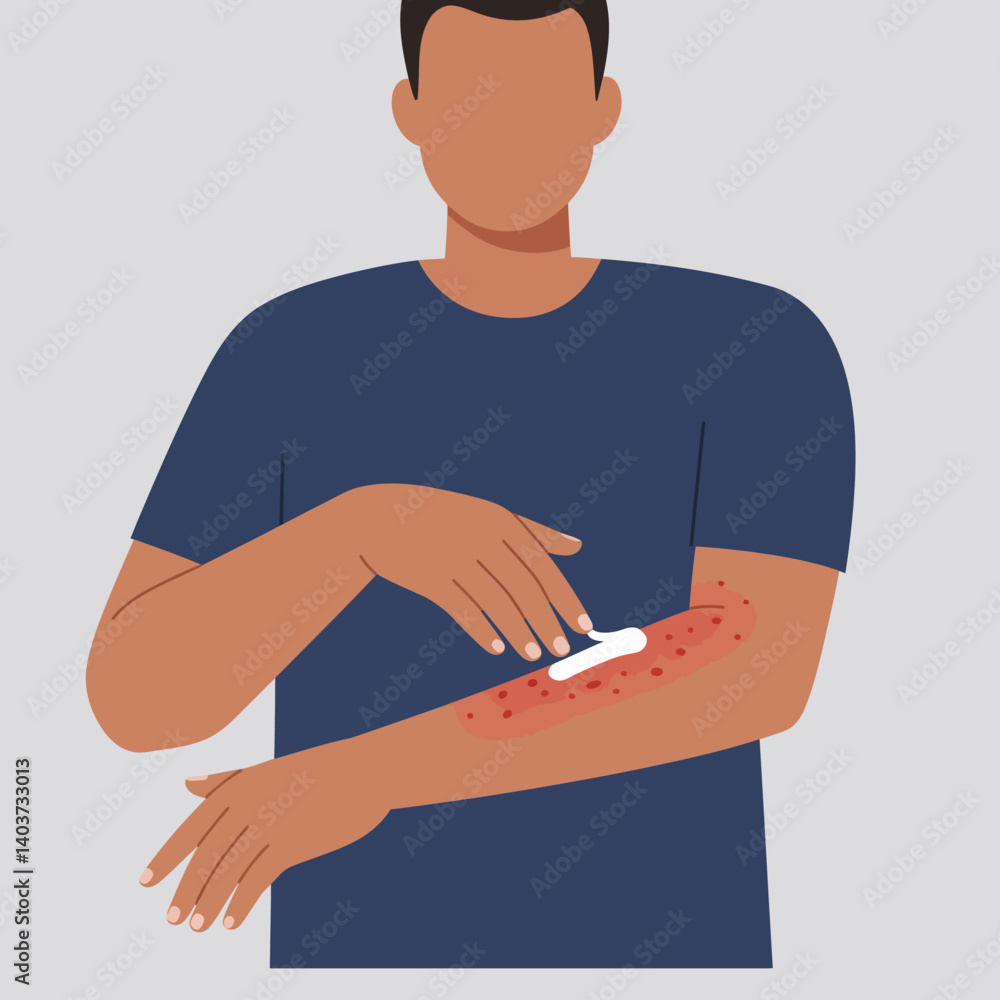 Man applying cream to irritated skin in flat vector illustration Man applying cream to irritated skin in flat vector illustration