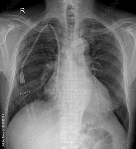 Chest X-ray Showing Central Venous Catheter and ECG Electrodes – AP View