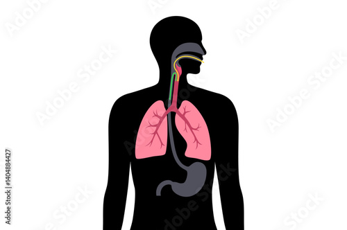 Aspiration pneumonia poster
