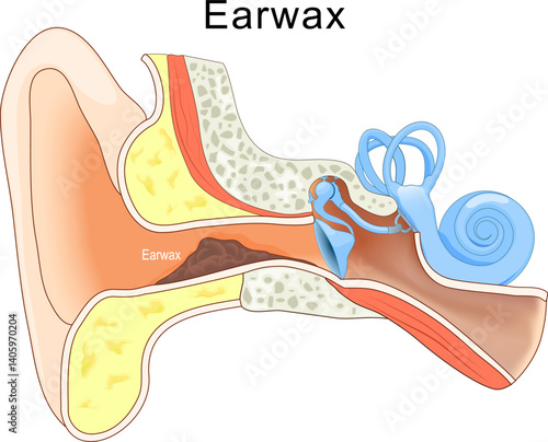 Earwax. ear with Cerumen in External auditory canal.