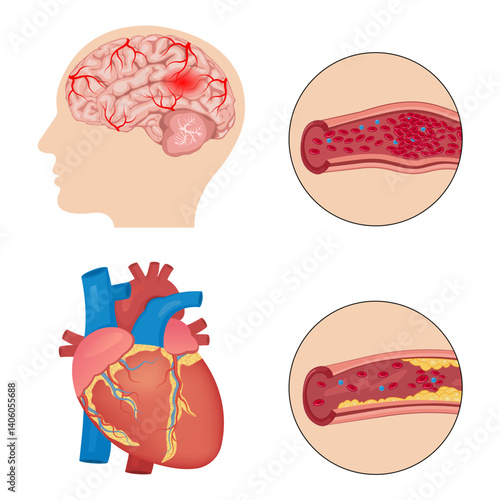cerebrovascular accident, stroke, or cerebral infarction with a thrombus or blood clot. Atherosclerosis concept, health risk. Human heart. 