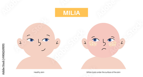 Milia face disease 