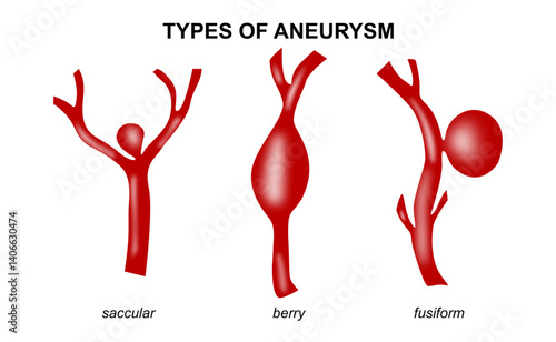 Types of Aneurysm Illustration Brain