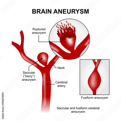 Brain Aneurysm Illustration ruptured aneurysm
