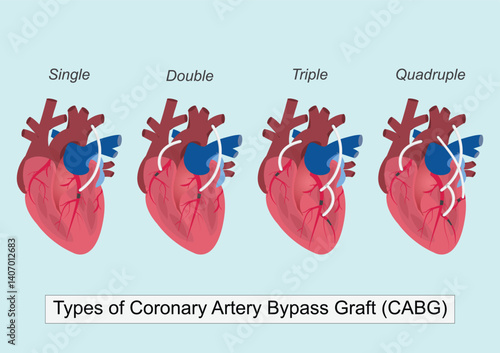 Types of Bypass surgery (Coronary Artery Bypass Grafting or CABG)