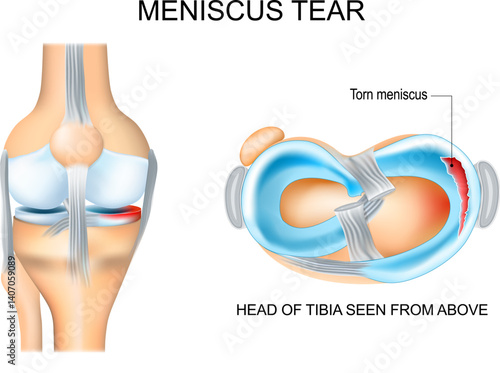 Meniscus tear
