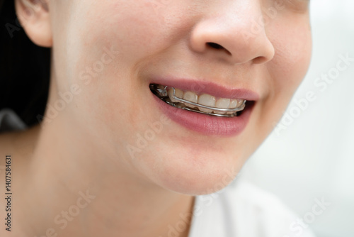 Asian woman wearing Hawley retainer removable orthodontic appliance maintain position of teeth.