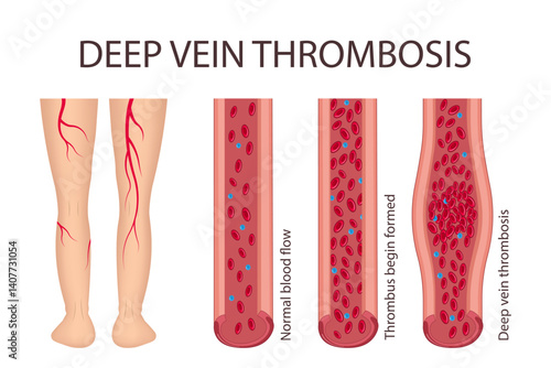 Medical diagram of deep vein thrombosis in the leg area. Illustration of blood flow disorder