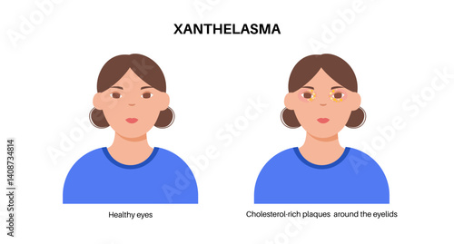 Xanthelasma skin disease