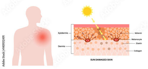 Skin damage from sunburn