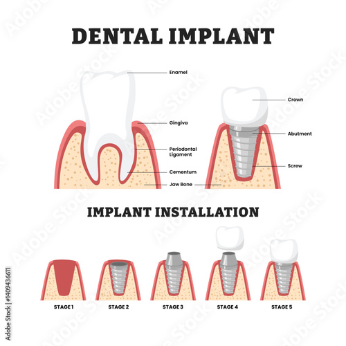 Dental Implant Structure and Installation Stages Infographic,  educational medical poster design healthcare scheme, labeled dental crown process. Medical Tooth Diagram for Oral Surgery, Dental Care