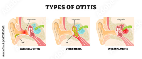 Different types of otitis types, educational medical poster design healthcare scheme, labeled external otitis, otitis media and internal otitis. Ear canal infection or inflammation tinnitus.