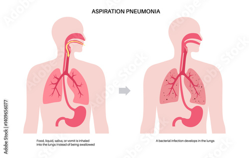 Aspiration pneumonia poster