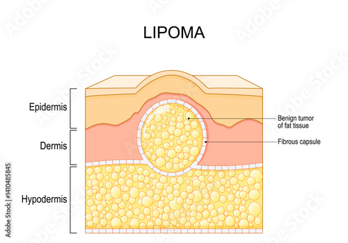 Lipoma. Cross section of a human skin with a fatty lump