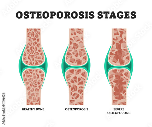 Stages of osteoporosis stages process, educational medical poster design healthcare scheme, labeled bone tissue close-up with different density. Skeletal system disease stages. Senior osteopathy.