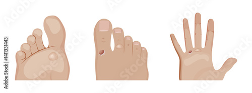 Friction blisters developing on foot and hand skin