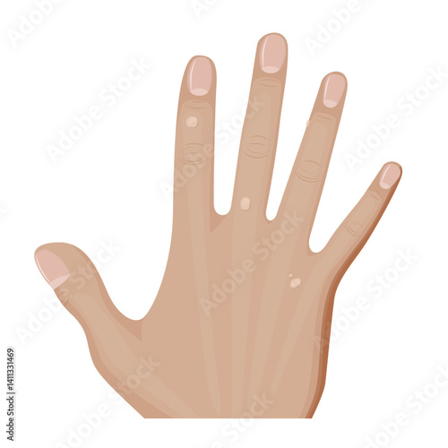 Hand showing common warts on skin