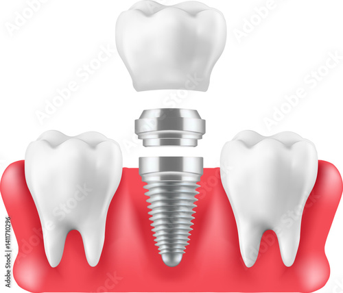  teeth with dental implant in gums over white background