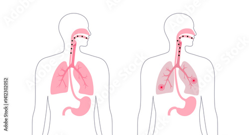 Aspiration pneumonia poster