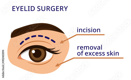 Plastic surgery concept vector illustration. Eyelid surgery with labeled incision and skin removal steps, for use in medical presentations, patient education, cosmetic clinics.Eyelid Surgery Diagram