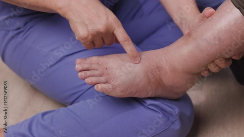 Elderly woman has edema or swelling foot.