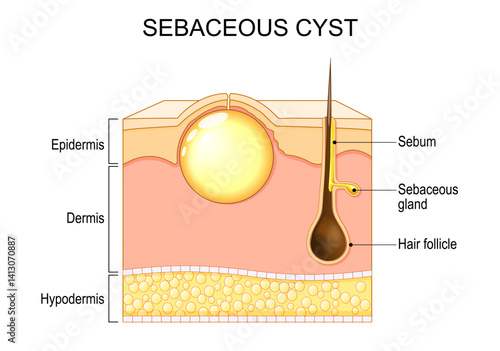 Wen. pilar cyst. Trichilemmal cyst. Sebaceous cyst